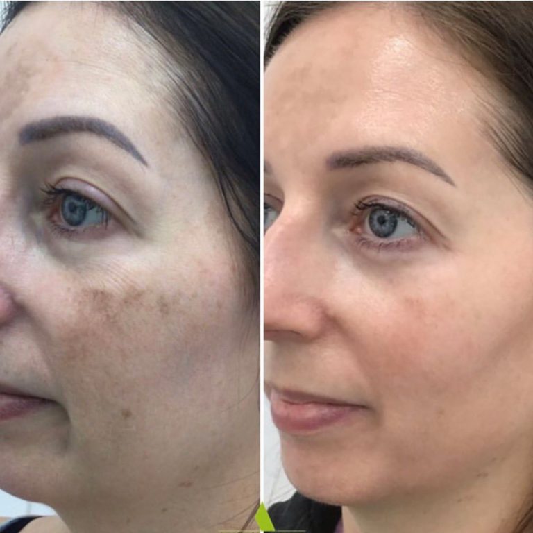 Skin Peels before and after results at Aesthetics of Essex