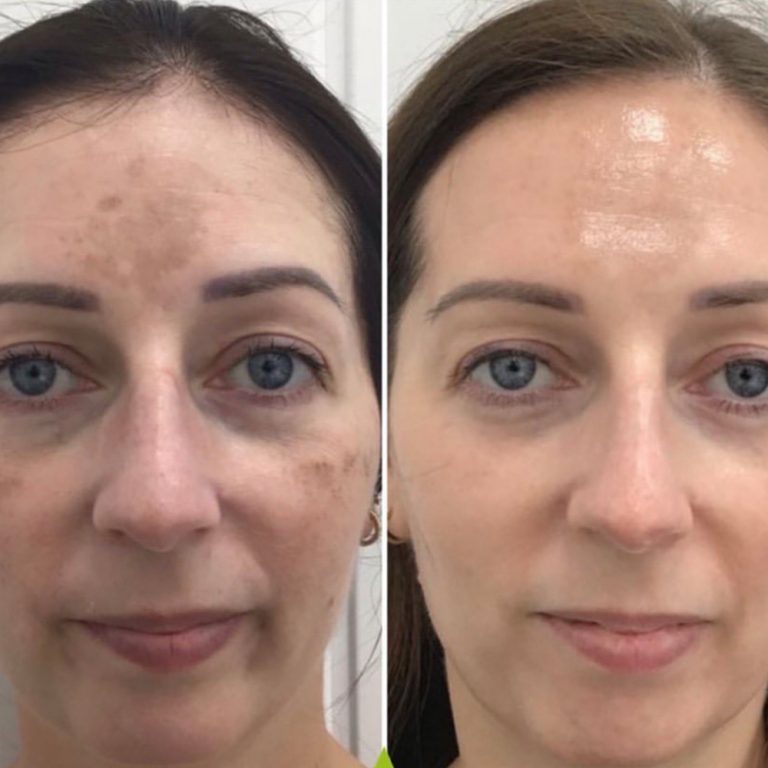 Skin Peels before and after results at Aesthetics of Essex
