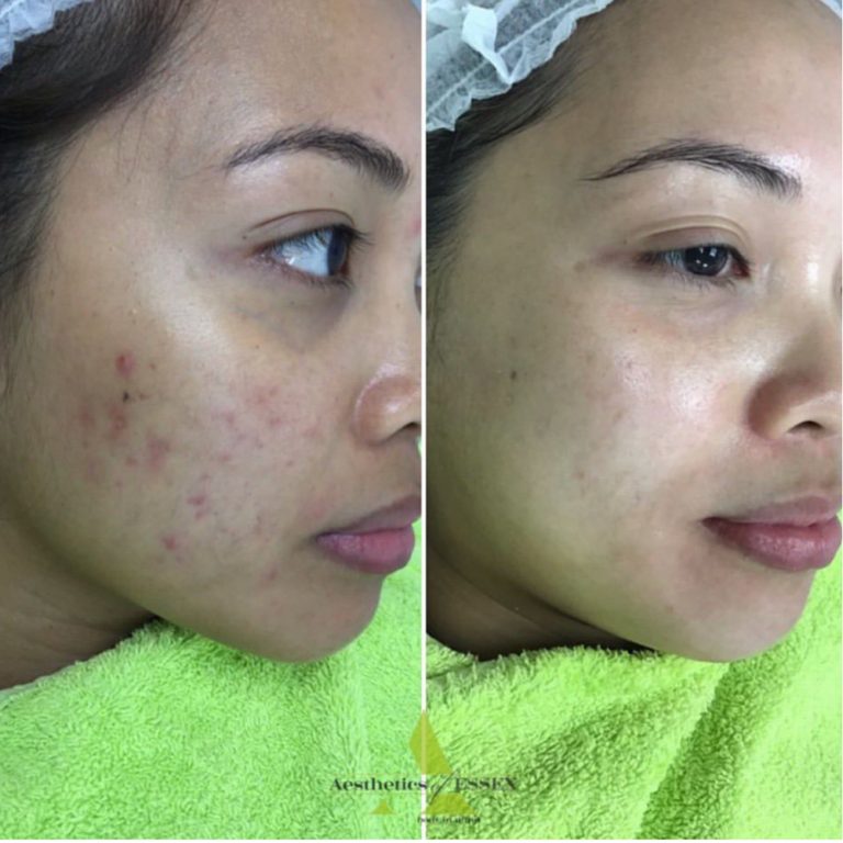 Skin Peels before and after results at Aesthetics of Essex