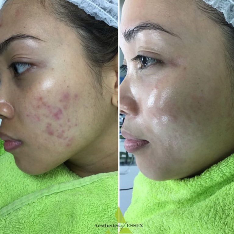 Skin Peels before and after results at Aesthetics of Essex