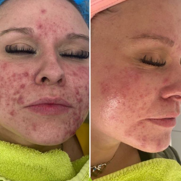 Skin Peels before and after results at Aesthetics of Essex