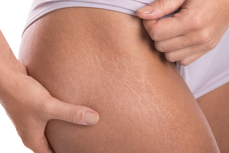 stretch marks