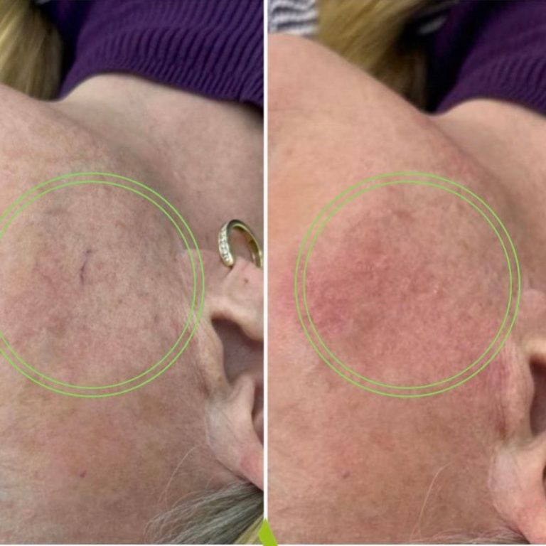 ThermaVein before and after results at Aesthetics of Essex