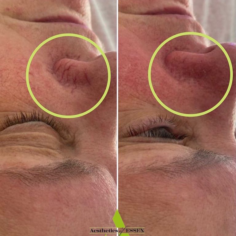 ThermaVein before and after results at Aesthetics of Essex