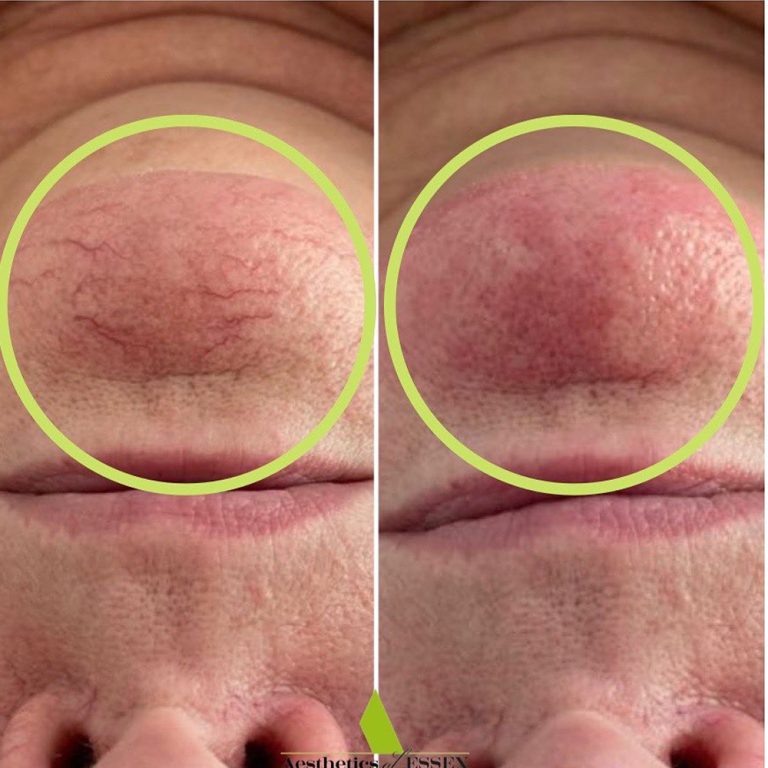 ThermaVein before and after results at Aesthetics of Essex