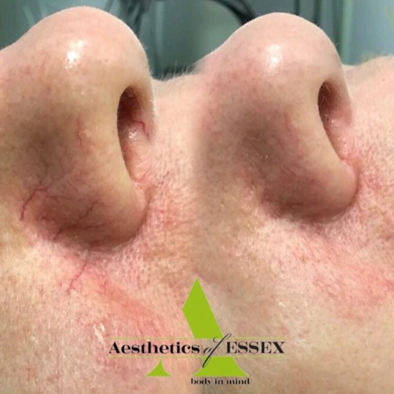 ThermaVein before and after results at Aesthetics of Essex