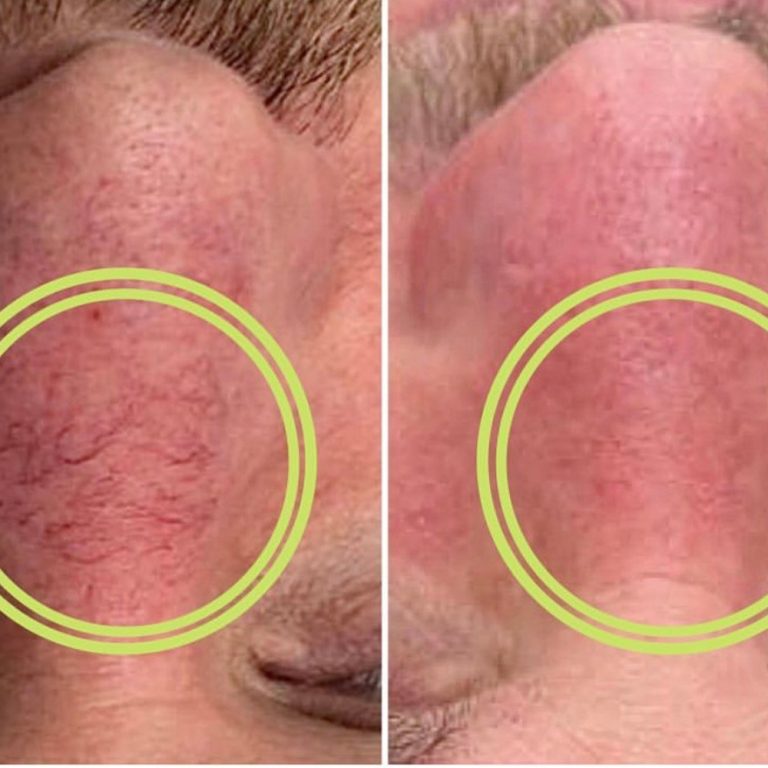 ThermaVein before and after results at Aesthetics of Essex