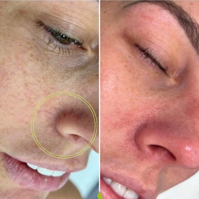 ThermaVein before and after results at Aesthetics of Essex