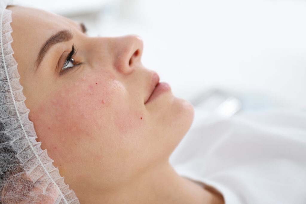 co2 laser essex skin results