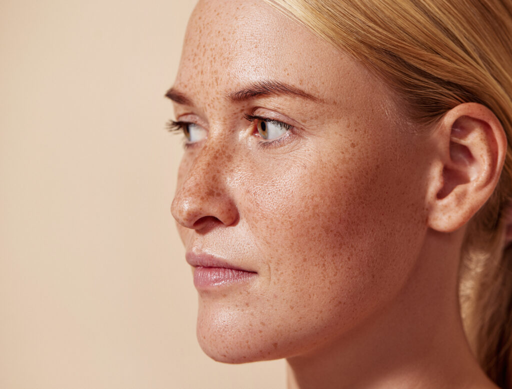 Showing IPL Essex treatment on skin